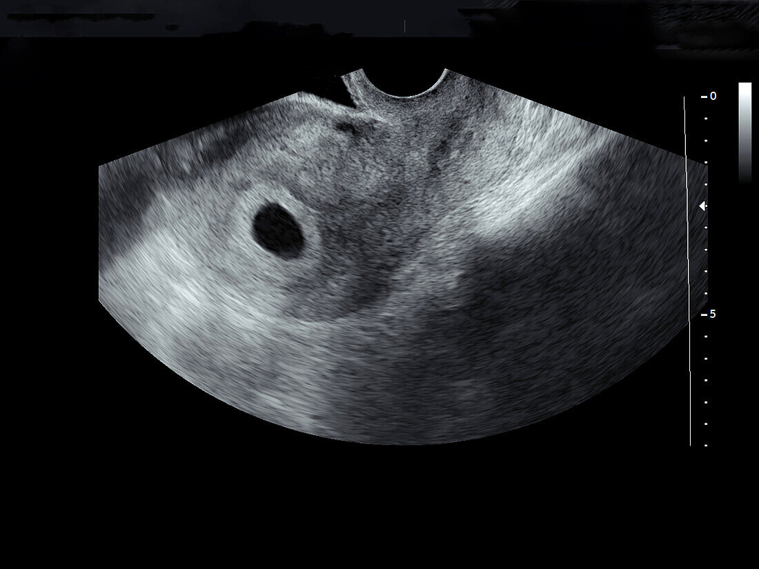 Embryo at six weeks, ultrasound scan