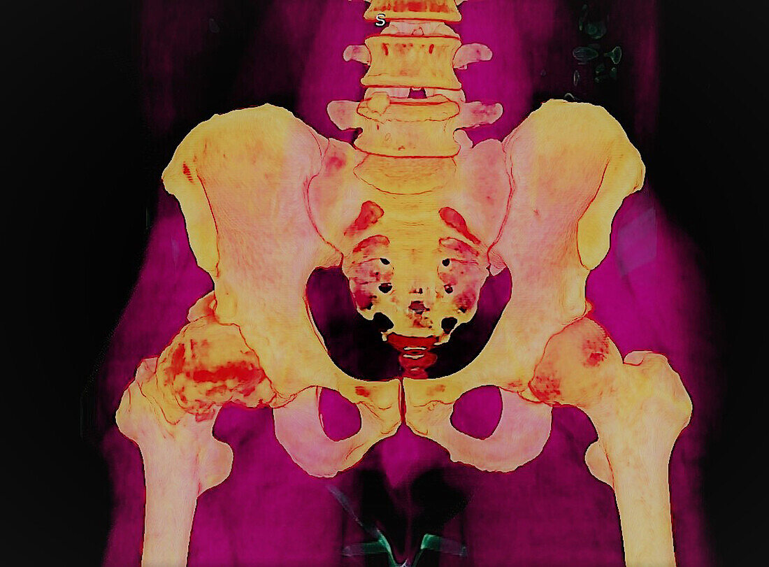 Osteoarthritis of the hip, 3D CT scan