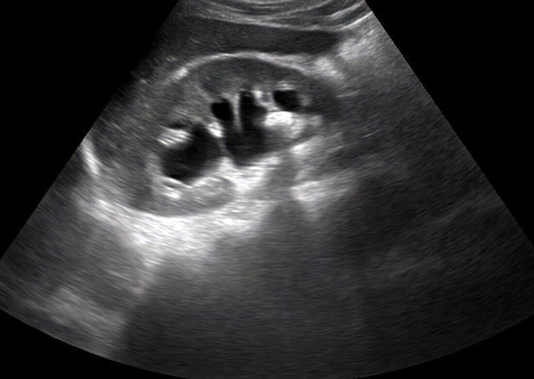 Kidney stone, ultrasound scan
