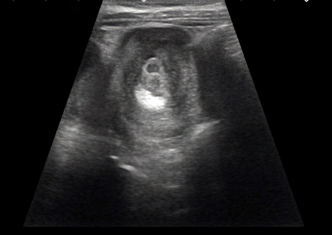 Intussusception of the intestines, ultrasound scan