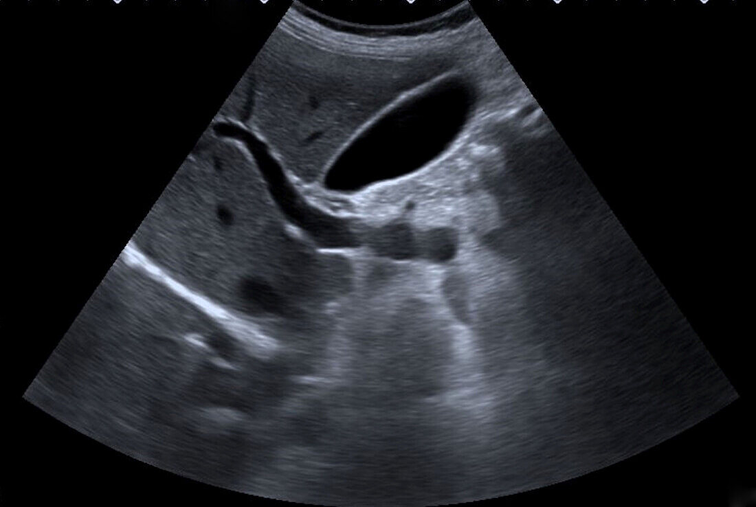 Gallbladder, ultrasound scan