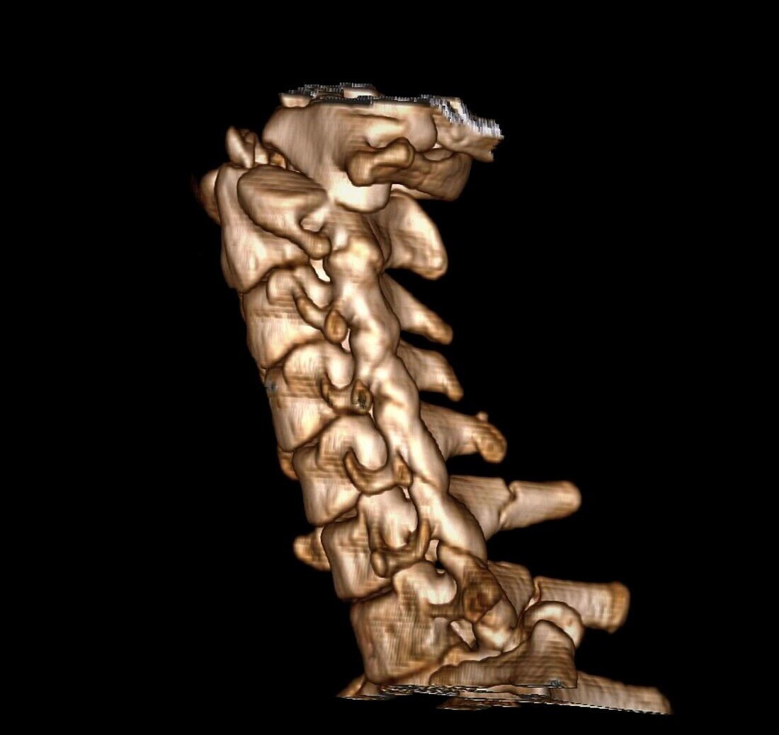 Dislocated neck bones, 3D CT scan
