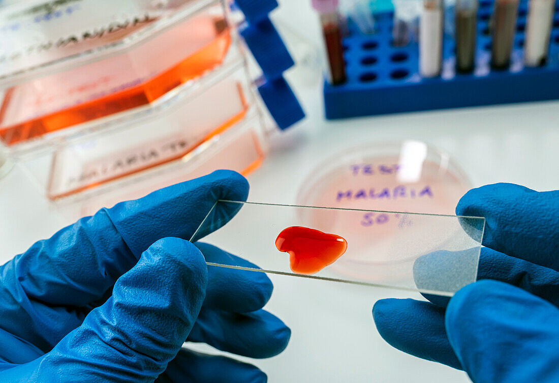 Scientist examining blood on a slide for malaria