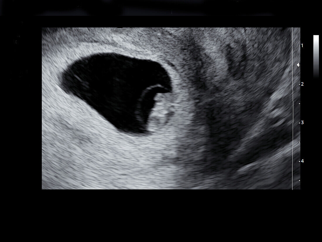 Embryo at seven weeks, ultrasound scan