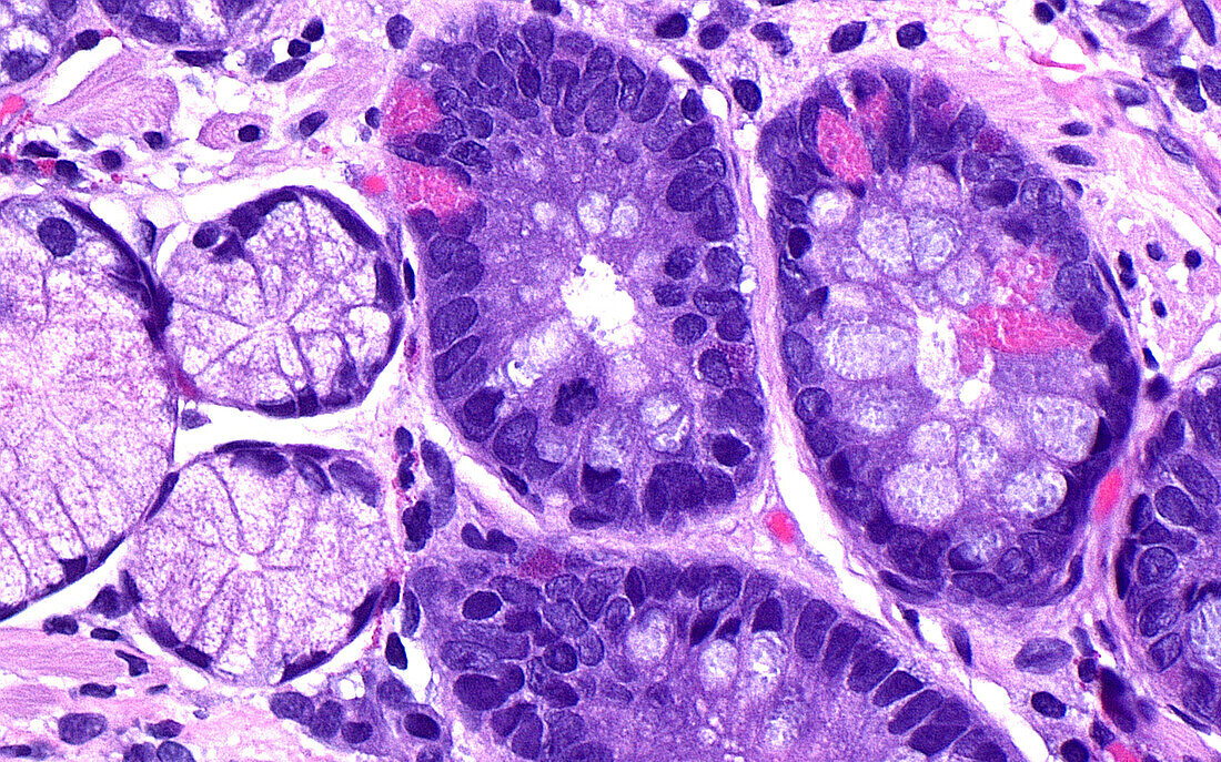 Intestinal metaplasia, light micrograph