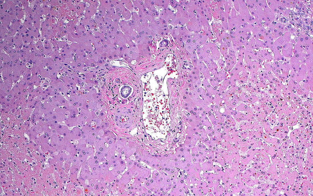 Liver ischemia, light micrograph