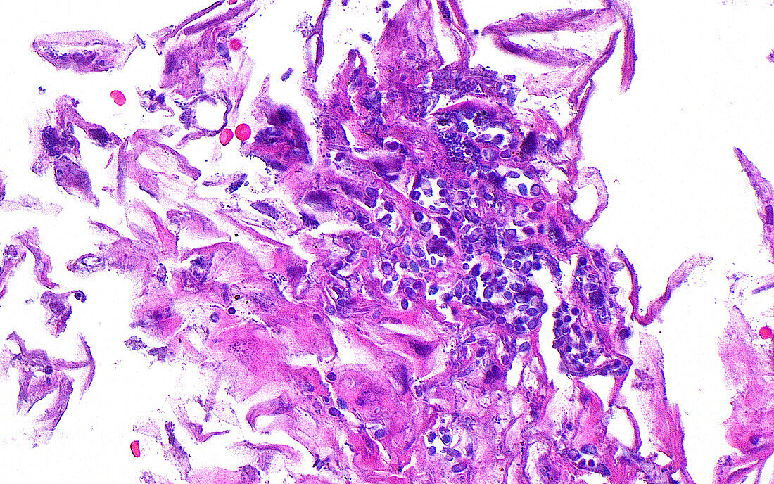 Candida fungal infection, light micrograph