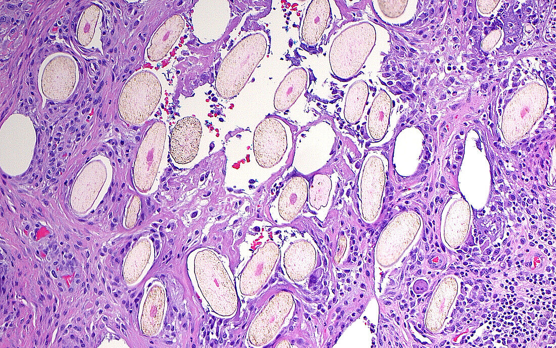 Pilonidal cyst, light micrograph