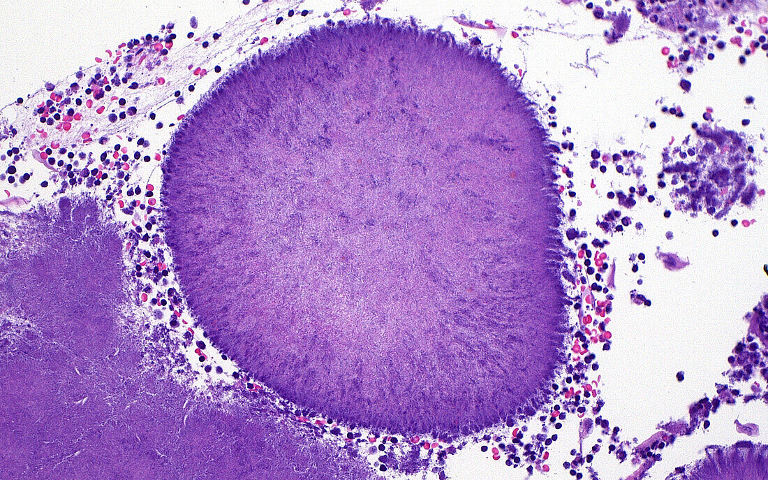 Bacteria in tonsil, light micrograph