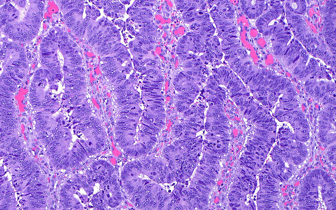 Colon cancer cells, light micrograph