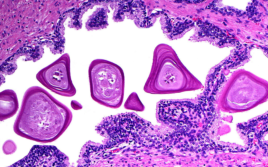 Prostate corpora amylacea, light micrograph