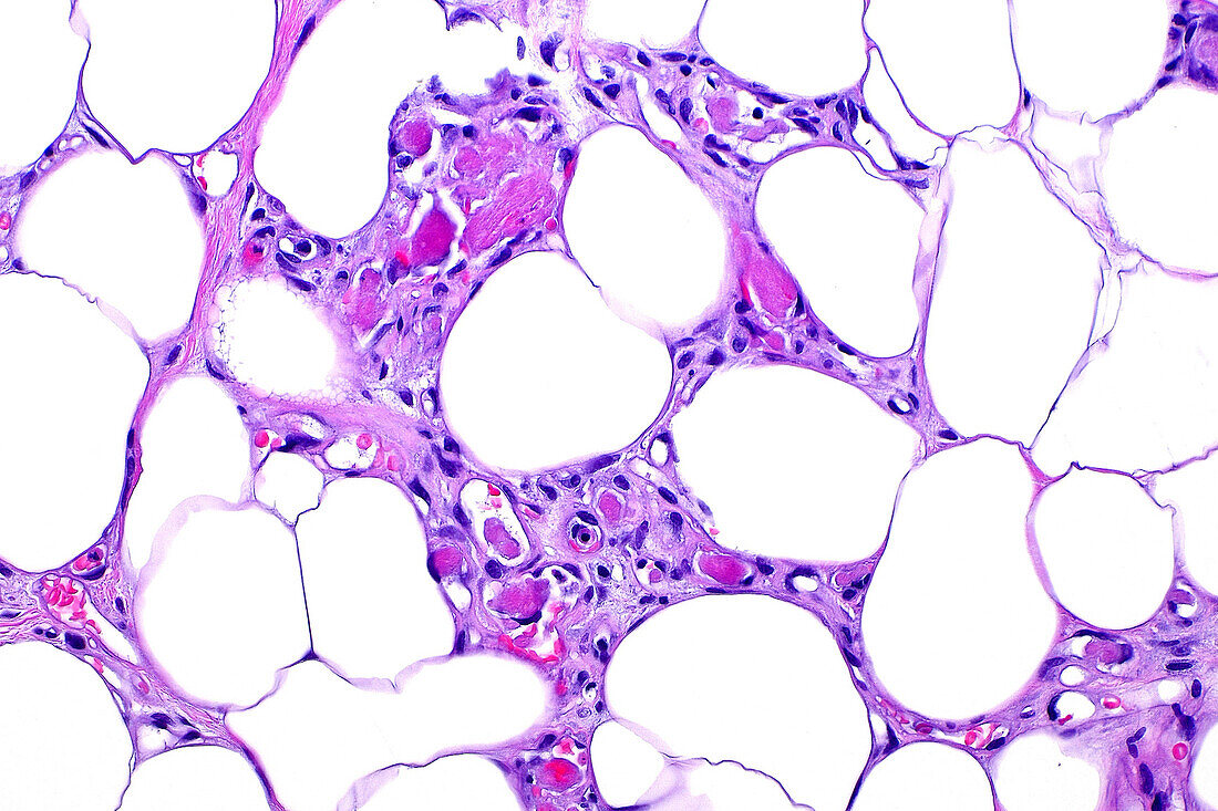 Angiolipoma benign fat tumour, light micrograph