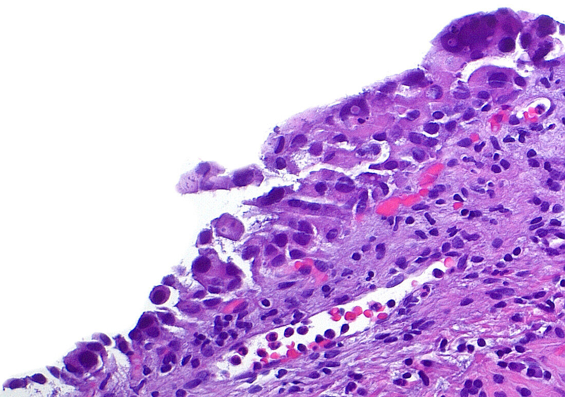 Bladder in situ cancer, light micrograph