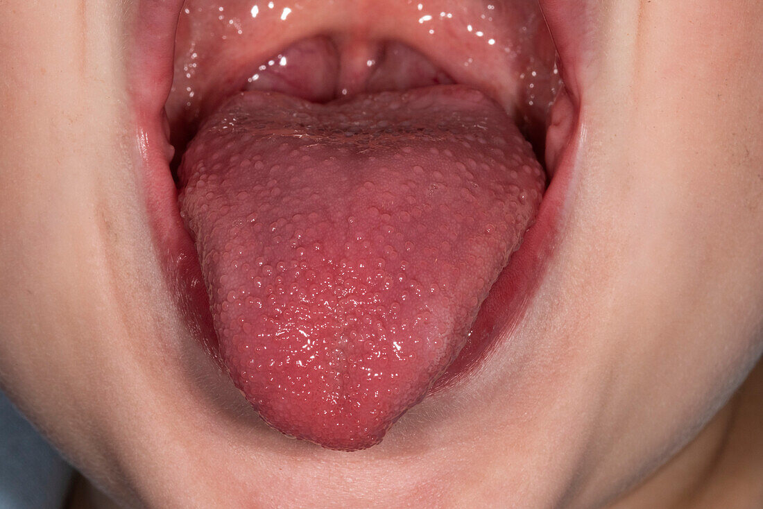 Strawberry tongue in scarlet fever