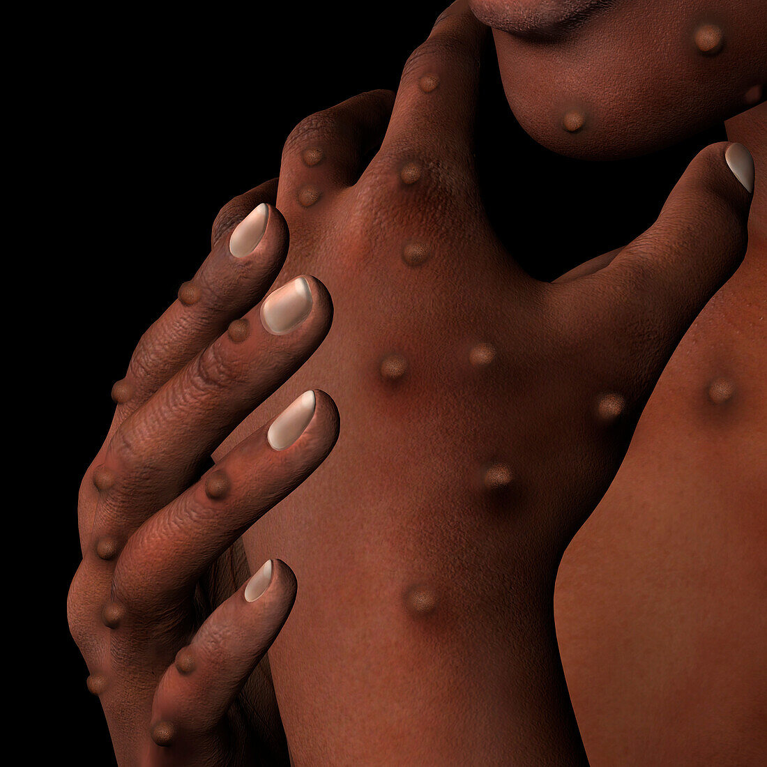 Monkeypox infection, illustration