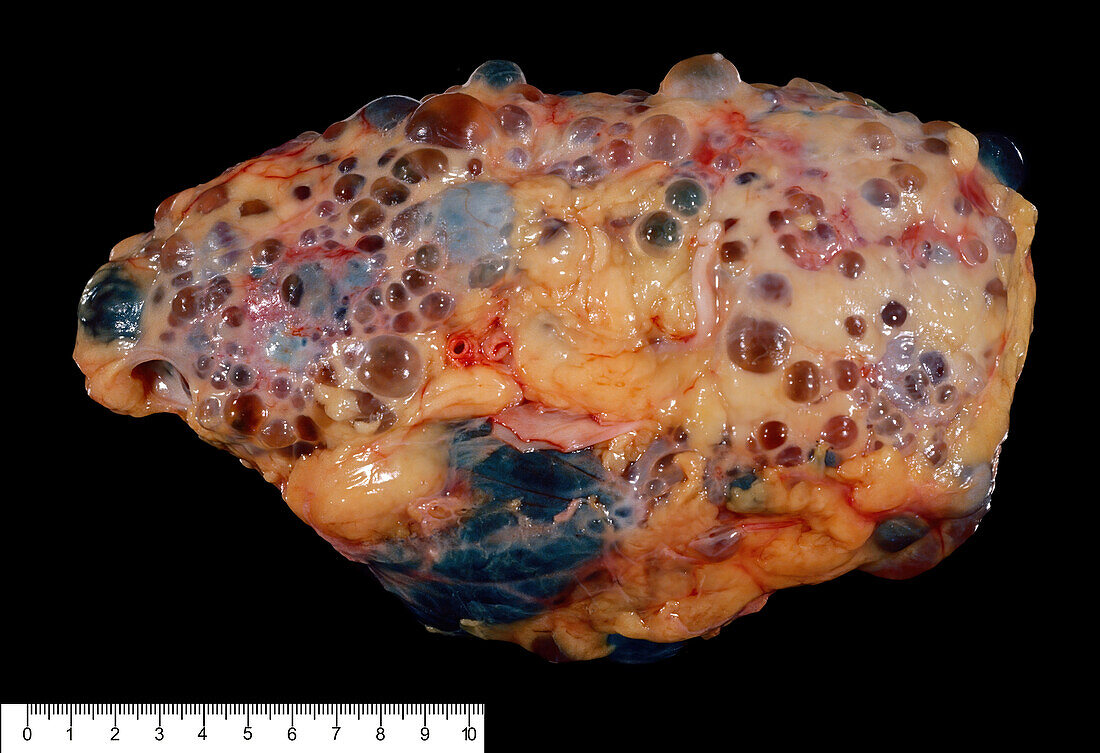 Human polycystic kidney