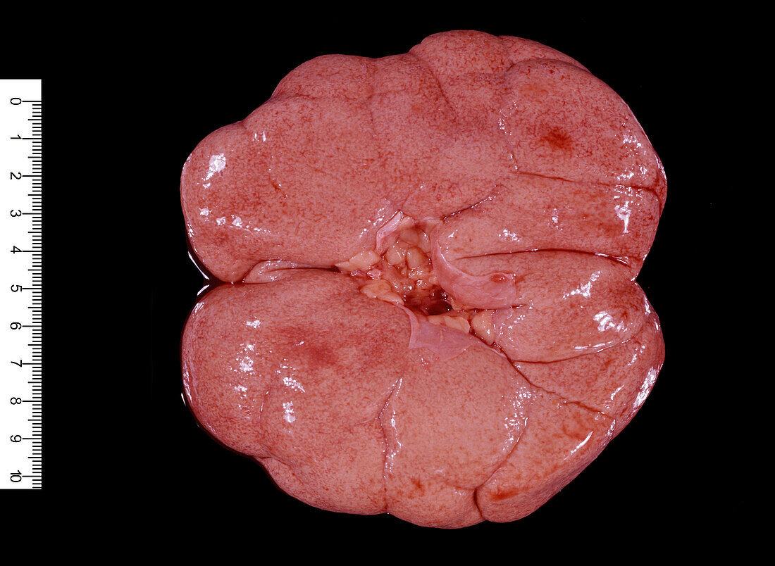 Human multilobular kidney