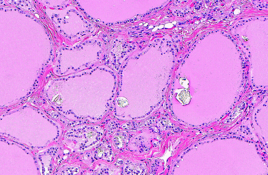 Oxalate crystals in normal thyroid, light micrograph