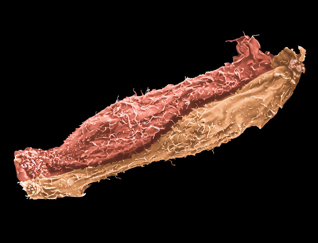 Skin cancer cells, SEM