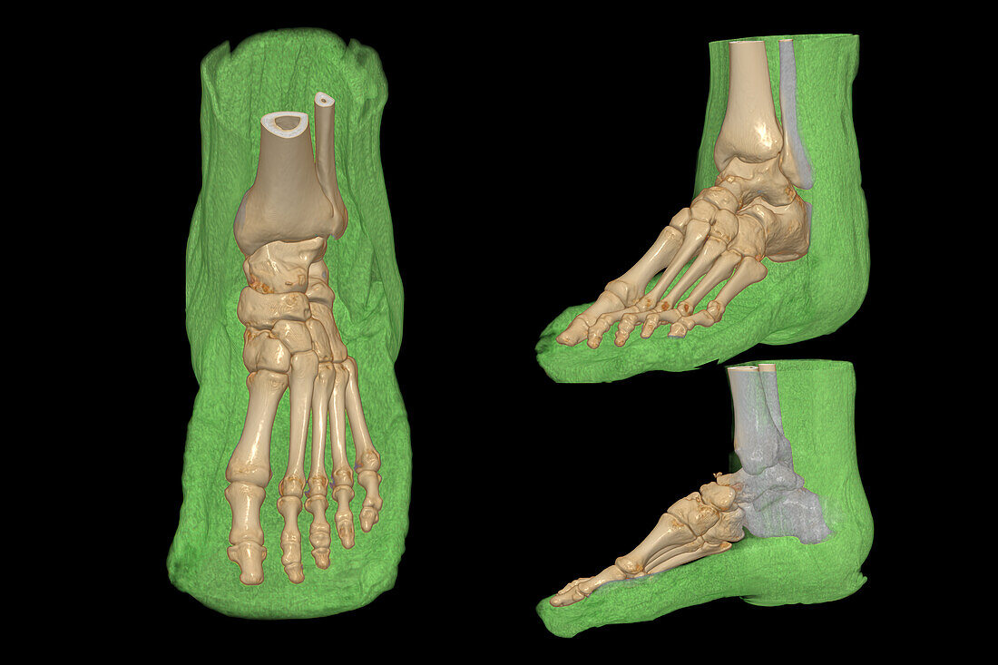 Foot, 3D CT scans