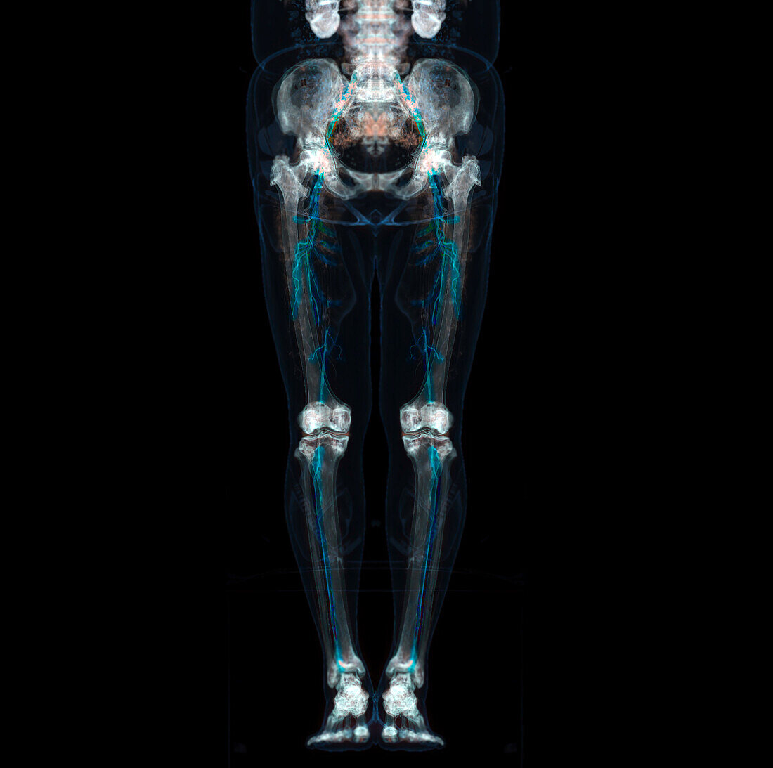Lower body, CT scan