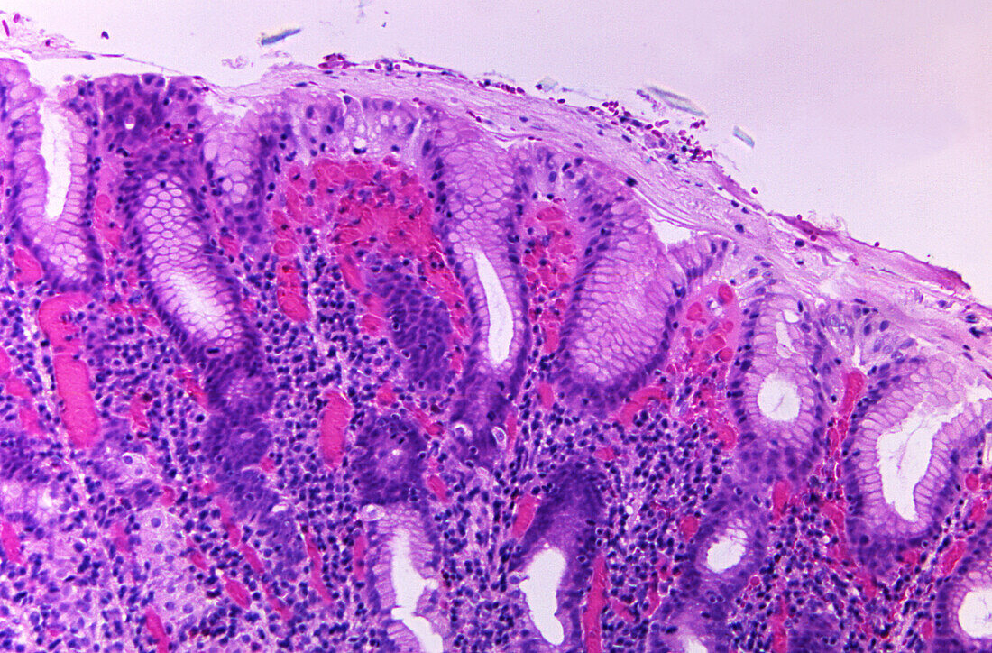 Gastric biopsy of a cholera patient, light micrograph