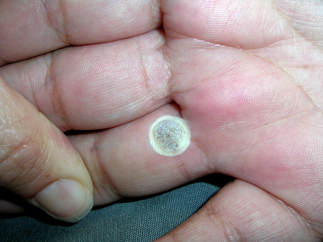 Wart treated with cryotherapy