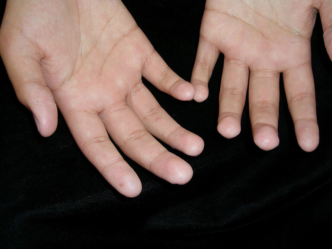 Warts treated with cimetidine