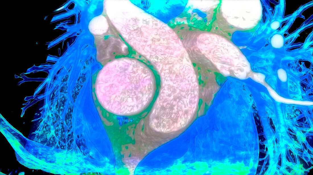 Aorta, pulmonary artery and vena cava, CT scan