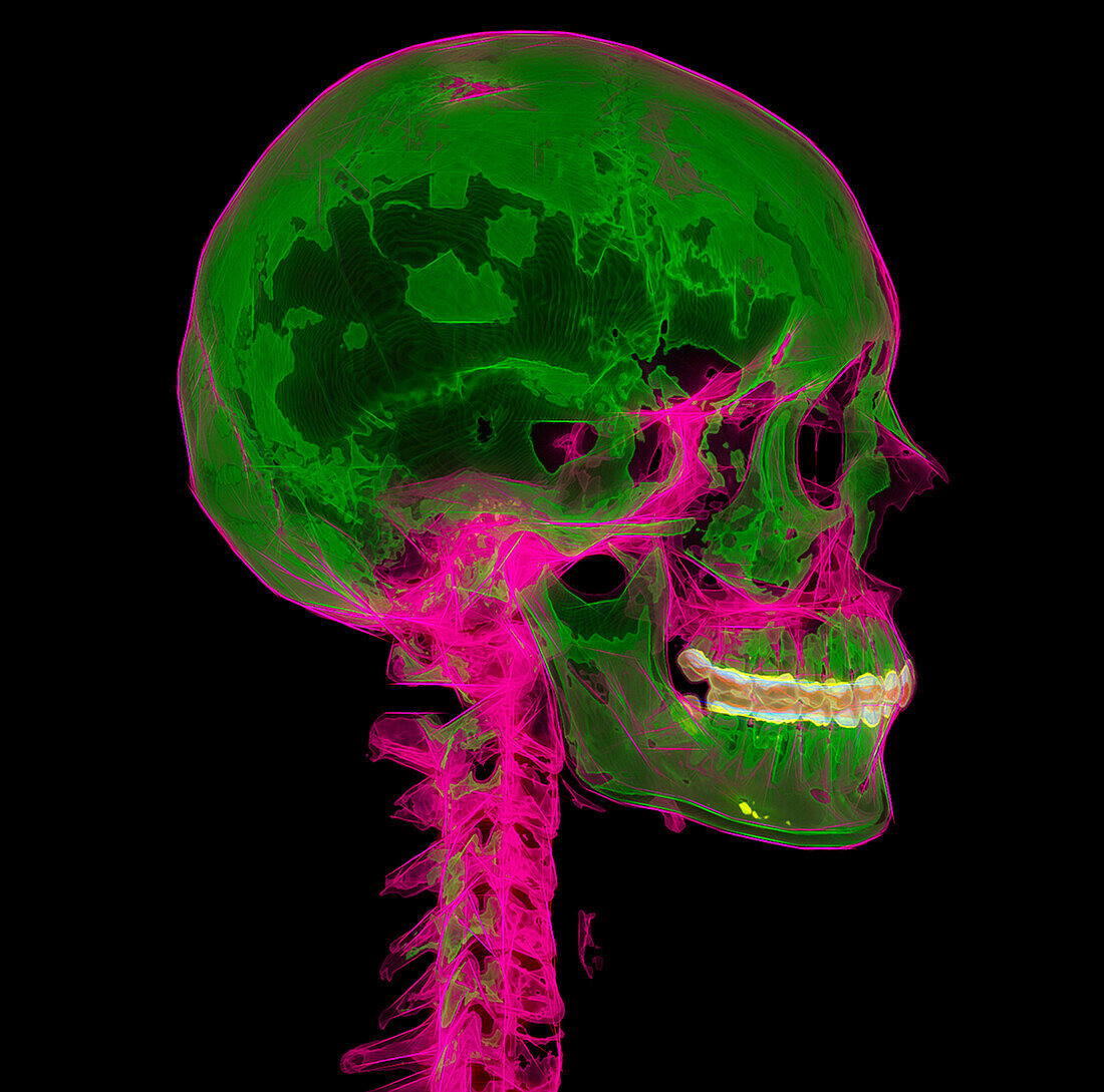 Head and neck bones, CT scan