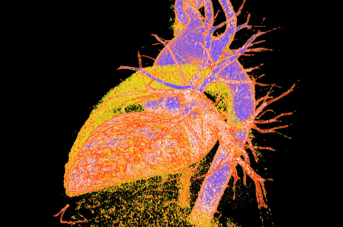 Healthy heart, CT scan