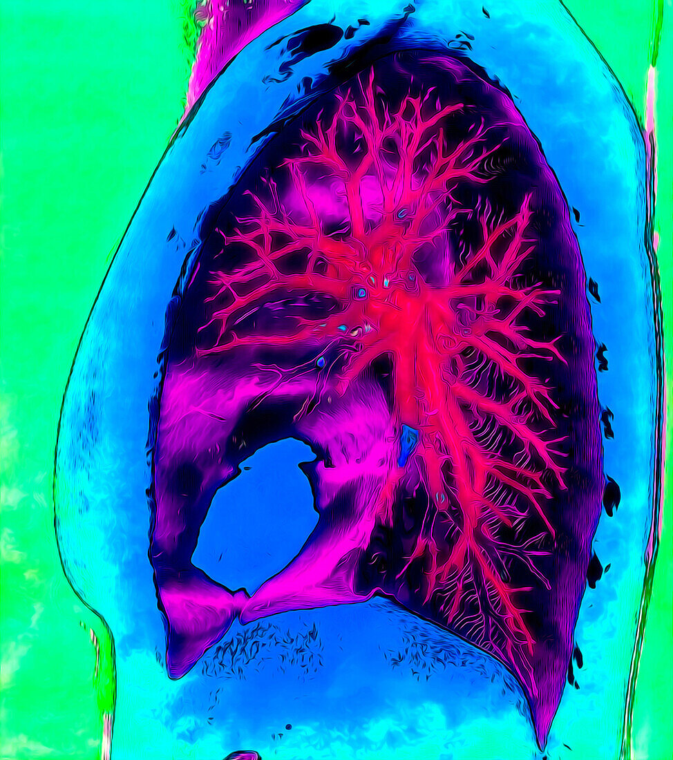 Healthy lung, CT scan