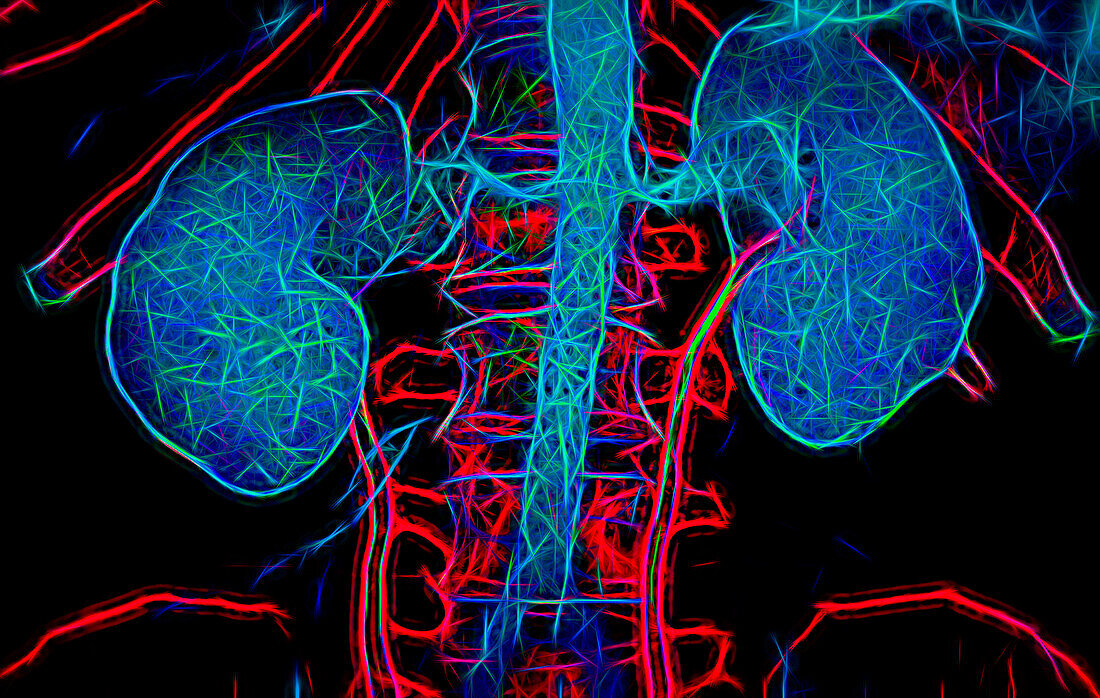 Kidneys, CT scan