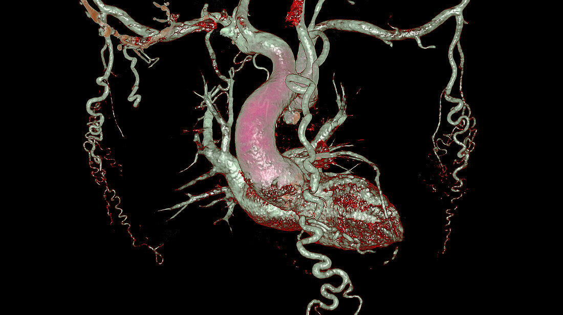 Collateral circulation in aortic coarctation, CT scan
