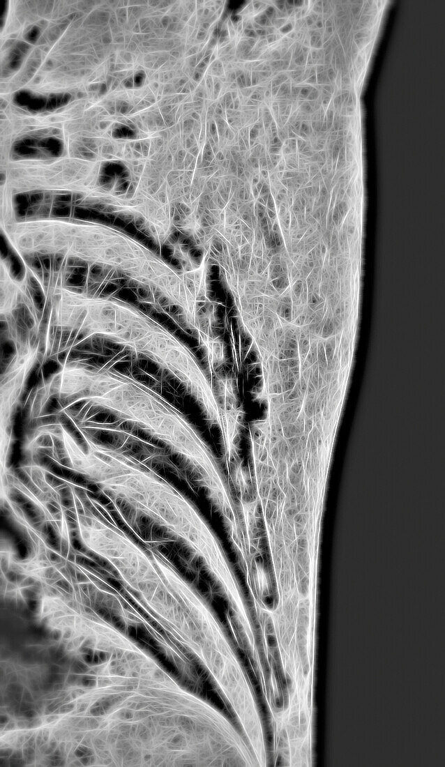 Ribs, CT scan