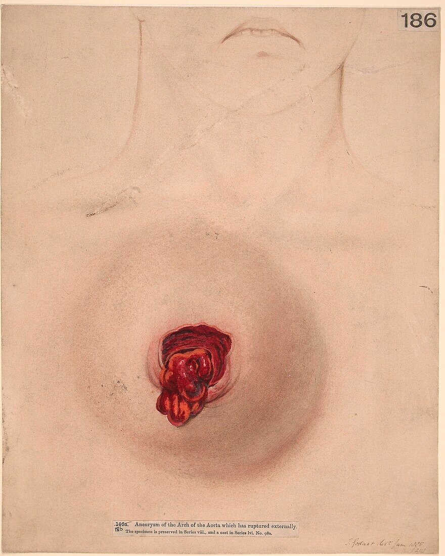 Ruptured aortic aneurysm, 19th century illustration