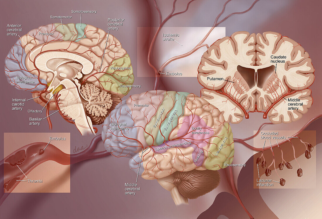 Anatomy of ischemic stroke, illustration