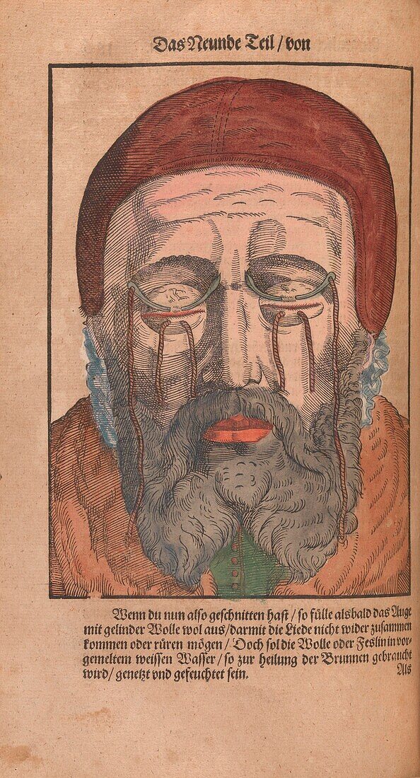 Eye surgery, 16th century illustration