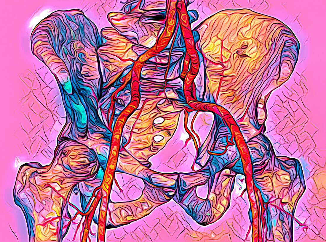 Iliac arteries, CT scan
