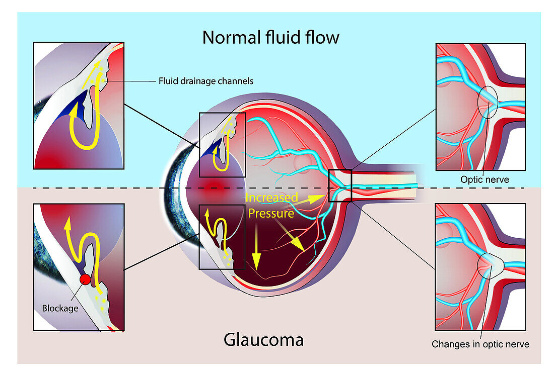Normal eye and eye with glaucoma, illustration