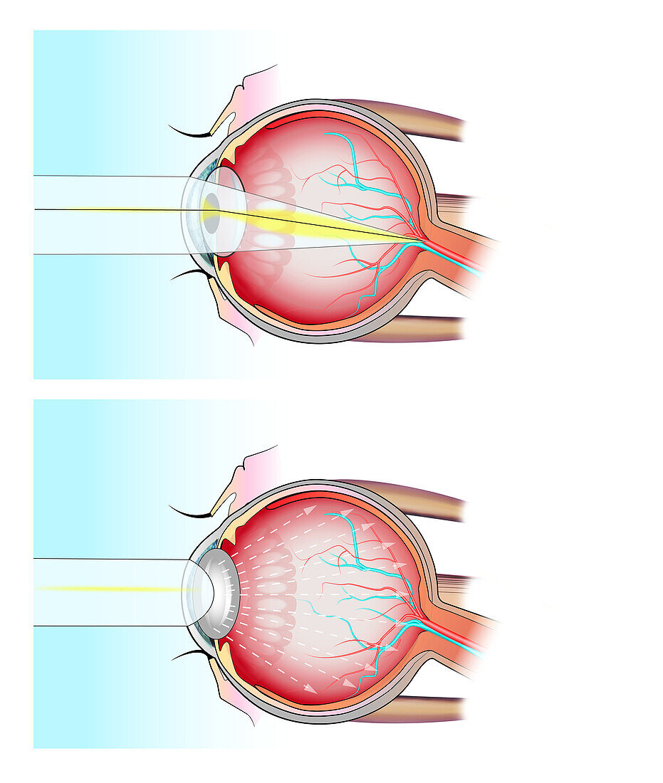 Normal eye and eye with cataract, illustration