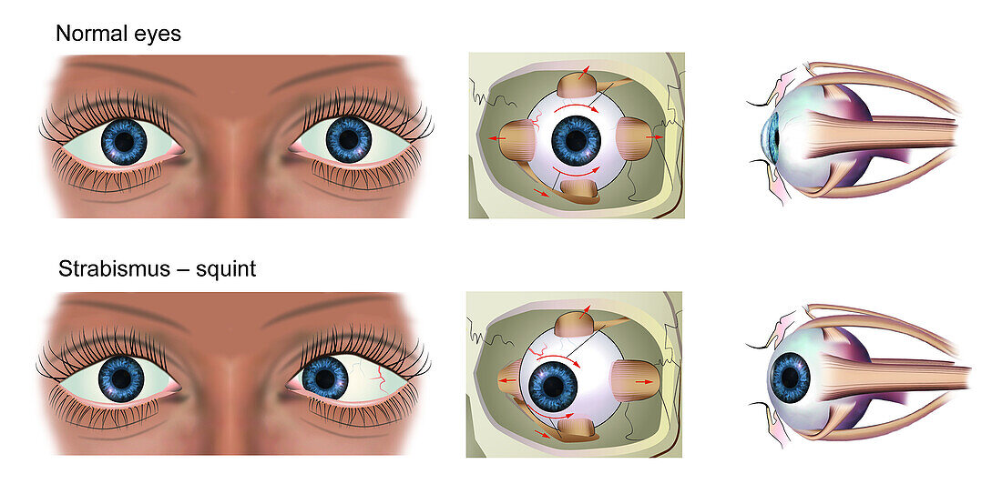 Normal eye and strabismus, illustration