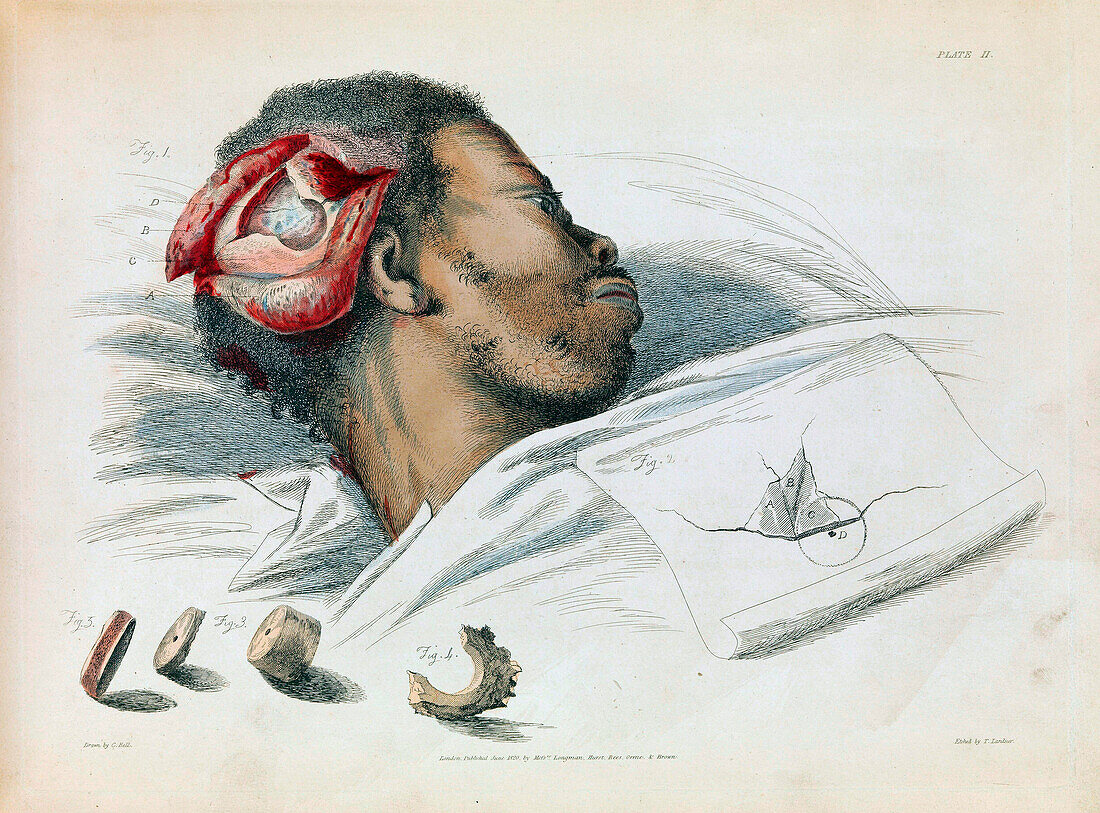 Trepanation, 19h century illustration