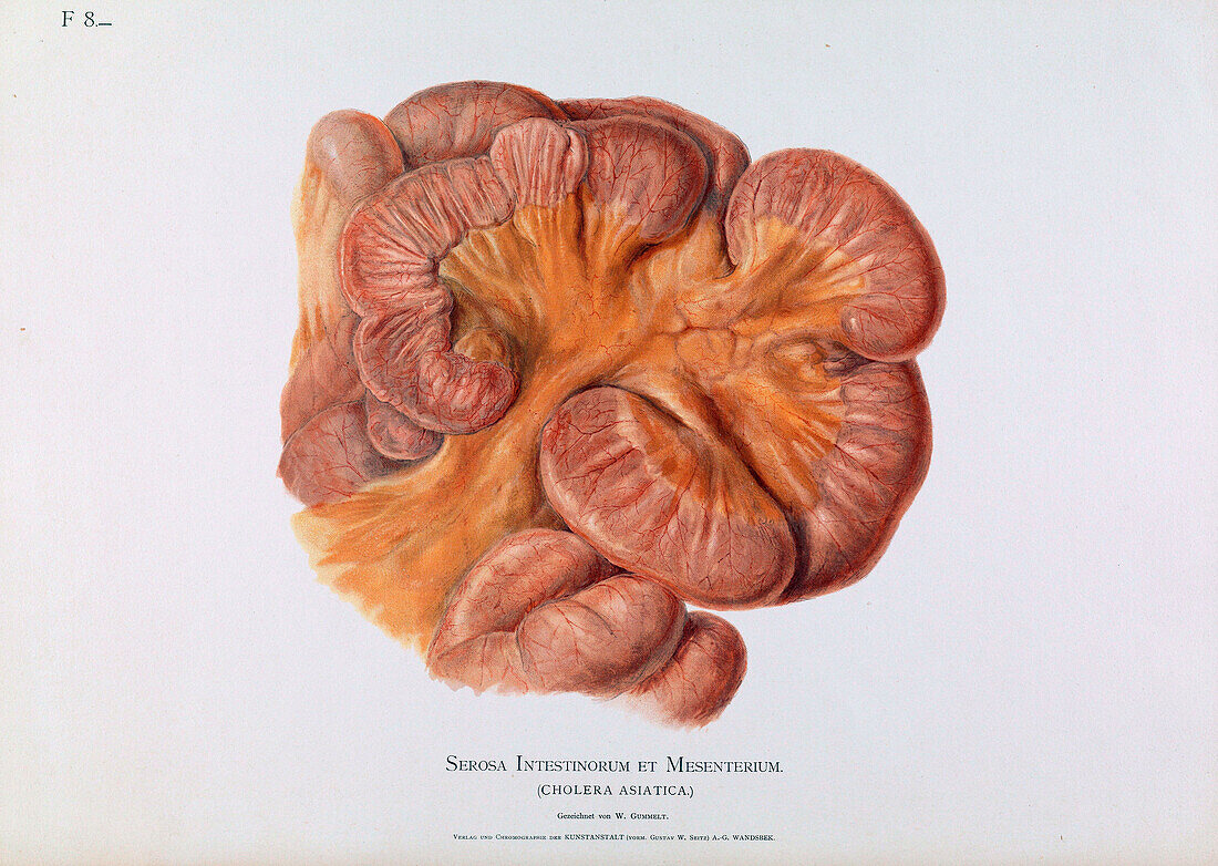 Intestine in cholera, 19thcentury illustration