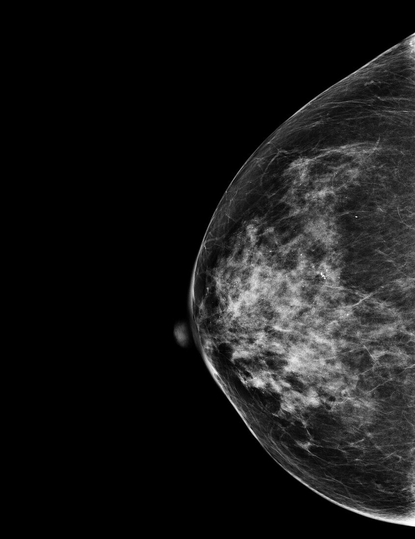 Normal mammogram