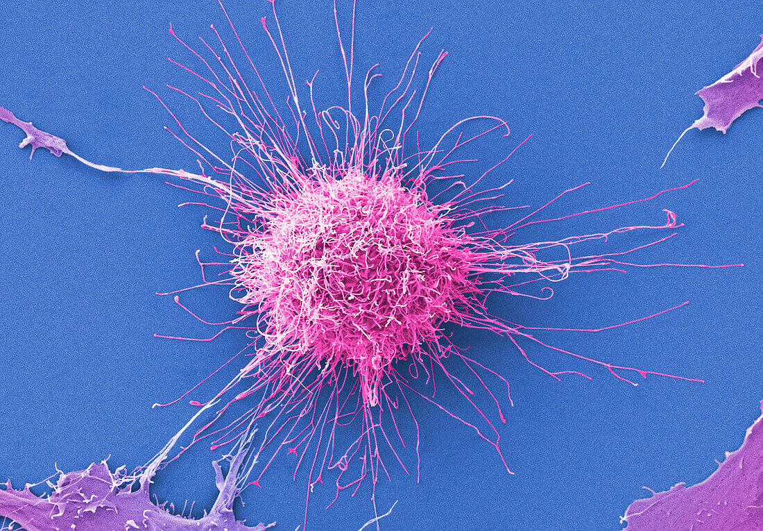 Cervical cancer cells, SEM