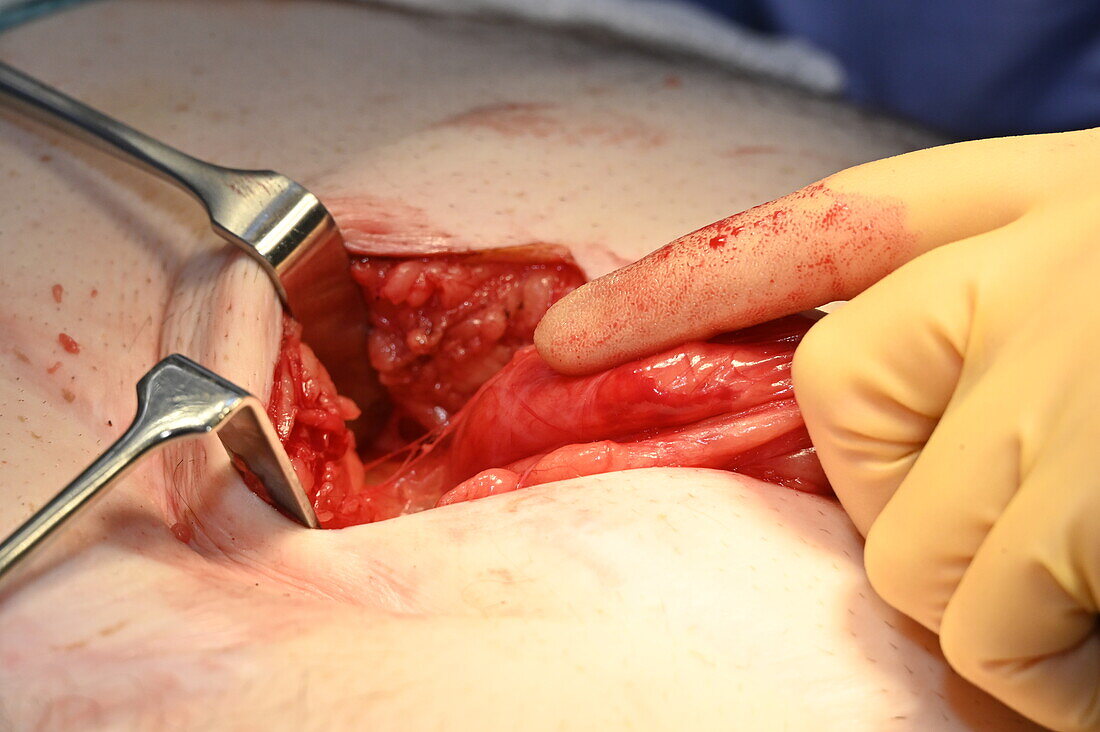 Incisional hernia repair operation