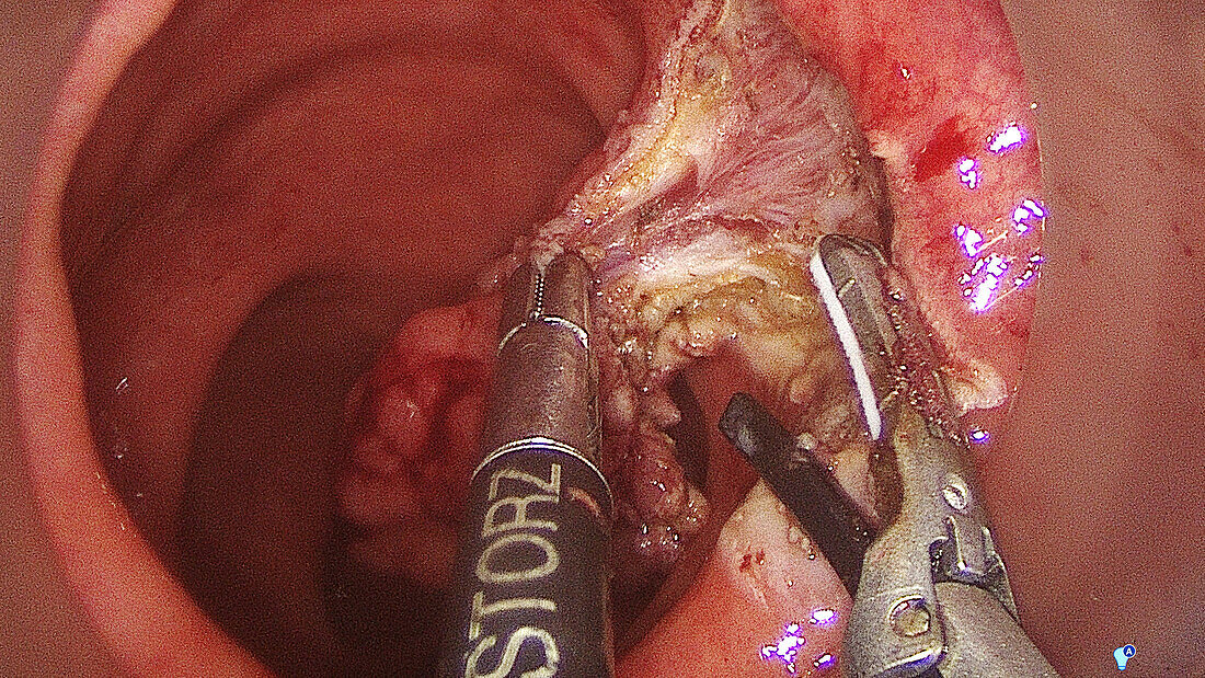 TAMIS polyp removal, endoscope view