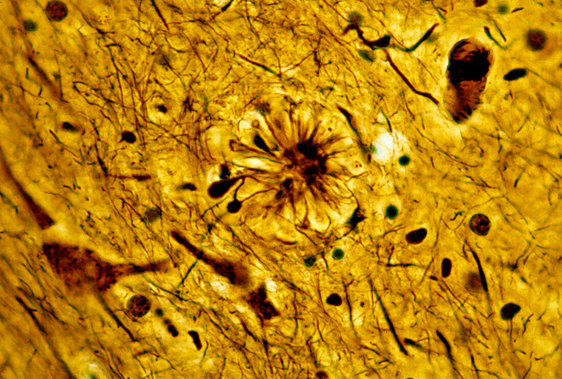 Senile plaque in cerebral cortex, light micrograph