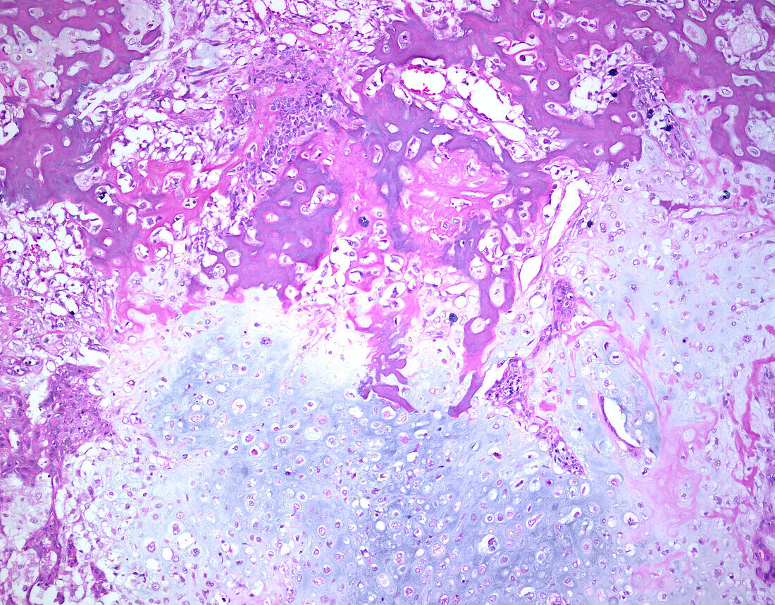 Carcinosarcoma, light micrograph